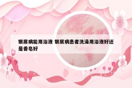 銀屑病能用浴液 銀屑病患者洗澡用浴液好還是香皂好