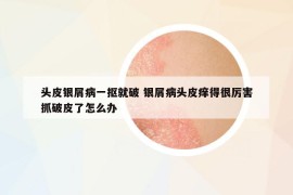 頭皮銀屑病一摳就破 銀屑病頭皮癢得很厲害抓破皮了怎么辦