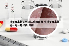 孩子身上長了一塊紅癬的東西 小孩子身上起的一片一片紅的,像癬