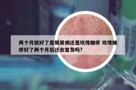 兩個(gè)月就好了是銀屑病還是玫瑰糠疹 玫瑰糠疹好了兩個(gè)月后還會(huì)復(fù)發(fā)嗎?