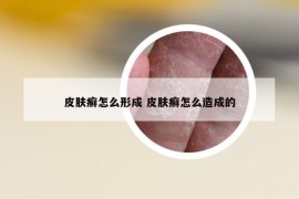 皮膚癬怎么形成 皮膚癬怎么造成的