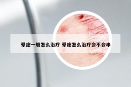 暈痣一般怎么治療 暈痣怎么治療會(huì)不會(huì)串