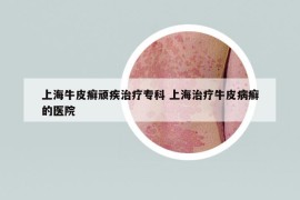 上海牛皮癬頑疾治療專科 上海治療牛皮病癬的醫(yī)院