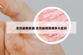 急性副銀屑病 急性副銀屑病多久能好
