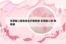 甘草酸二胺用來(lái)治療銀屑病 甘草酸二銨 銀屑病