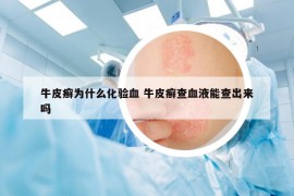 牛皮癬為什么化驗(yàn)血 牛皮癬查血液能查出來(lái)嗎