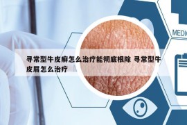 尋常型牛皮癬怎么治療能徹底根除 尋常型牛皮屑怎么治療
