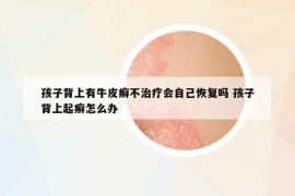 孩子背上有牛皮癬不治療會(huì)自己恢復(fù)嗎 孩子背上起癬怎么辦