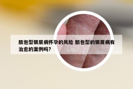 膿包型銀屑病懷孕的風險 膿包型的銀屑病有治愈的案例嗎?