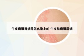 牛皮癬銀肖病是怎么染上的 牛皮膚癬銀屑病