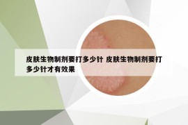 皮膚生物制劑要打多少針 皮膚生物制劑要打多少針才有效果