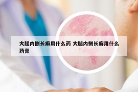 大腿內側長癬用什么藥 大腿內側長癬用什么藥膏