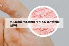 小兒白斑是什么原因圖片 小兒白斑嚴(yán)重嗎能治好嗎