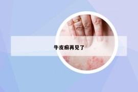 牛皮癬再見了