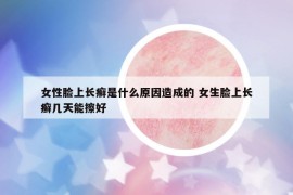 女性臉上長癬是什么原因造成的 女生臉上長癬幾天能擦好