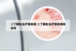 二丁顆粒治療銀屑病 二丁顆粒治療銀屑病有效嗎