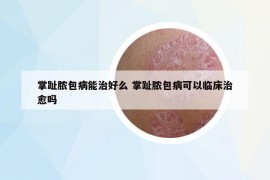 掌趾膿包病能治好么 掌趾膿包病可以臨床治愈嗎