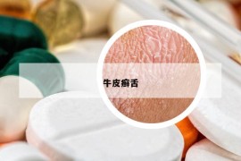 牛皮癬舌