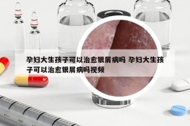 孕婦大生孩子可以治愈銀屑病嗎 孕婦大生孩子可以治愈銀屑病嗎視頻