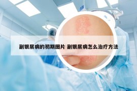 副銀屑病的初期圖片 副銀屑病怎么治療方法