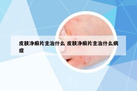 皮膚凈癬片主治什么 皮膚凈癬片主治什么病癥