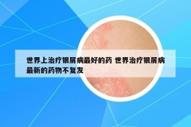 世界上治療銀屑病最好的藥 世界治療銀屑病最新的藥物不復發(fā)