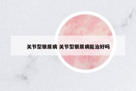 關(guān)節(jié)型銀屑病 關(guān)節(jié)型銀屑病能治好嗎