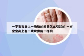 一歲寶寶身上一塊塊的癬是怎么引起的 一歲寶寶身上有一塊塊像癬一樣的