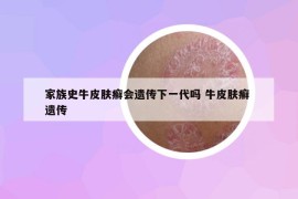 家族史牛皮膚癬會遺傳下一代嗎 牛皮膚癬 遺傳