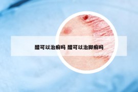 醋可以治癬嗎 醋可以治腳癬嗎