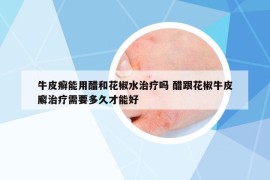 牛皮癬能用醋和花椒水治療嗎 醋跟花椒牛皮廨治療需要多久才能好