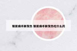 銀屑病手腳發(fā)熱 銀屑病手腳發(fā)熱吃什么藥