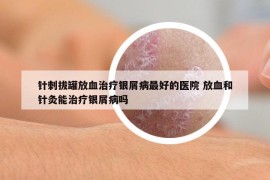 針刺拔罐放血治療銀屑病最好的醫(yī)院 放血和針灸能治療銀屑病嗎