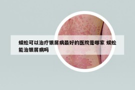 蜈蚣可以治療銀屑病最好的醫(yī)院是哪家 蜈蚣能治銀屑病嗎
