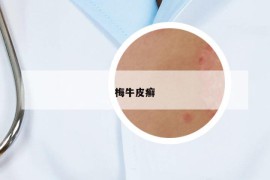 梅牛皮癬