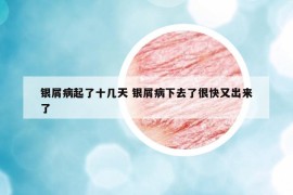 銀屑病起了十幾天 銀屑病下去了很快又出來(lái)了