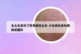 女兒頭皮長了好多癬怎么辦 小女孩頭皮長癬掉皮圖片