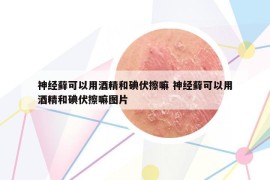 神經(jīng)蘚可以用酒精和碘伏擦嘛 神經(jīng)蘚可以用酒精和碘伏擦嘛圖片