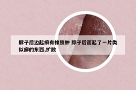 脖子后邊起癬有橡膠腫 脖子后面起了一片類似癬的東西,擴(kuò)散