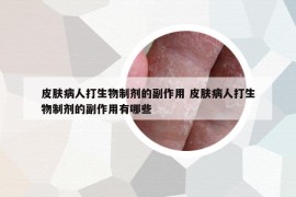 皮膚病人打生物制劑的副作用 皮膚病人打生物制劑的副作用有哪些