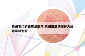 杭州專門的銀屑病醫(yī)院 杭州銀屑病哪種方法能可以治好