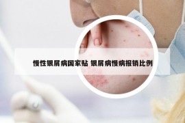 慢性銀屑病國(guó)家貼 銀屑病慢病報(bào)銷比例