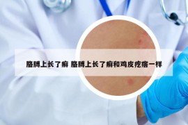 胳膊上長了癬 胳膊上長了癬和雞皮疙瘩一樣