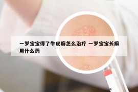 一歲寶寶得了牛皮癬怎么治療 一歲寶寶長癬用什么藥