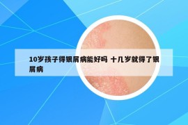 10歲孩子得銀屑病能好嗎 十幾歲就得了銀屑病