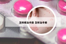 怎樣根治手蘚 怎樣治手癬