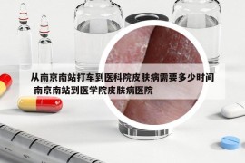 從南京南站打車到醫(yī)科院皮膚病需要多少時間 南京南站到醫(yī)學院皮膚病醫(yī)院