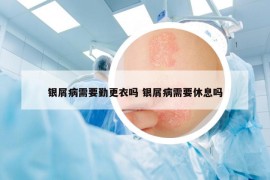 銀屑病需要勤更衣嗎 銀屑病需要休息嗎