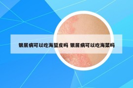 銀屑病可以吃海蜇皮嗎 銀屑病可以吃海菜嗎