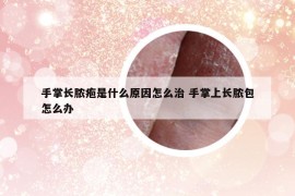 手掌長膿皰是什么原因怎么治 手掌上長膿包怎么辦